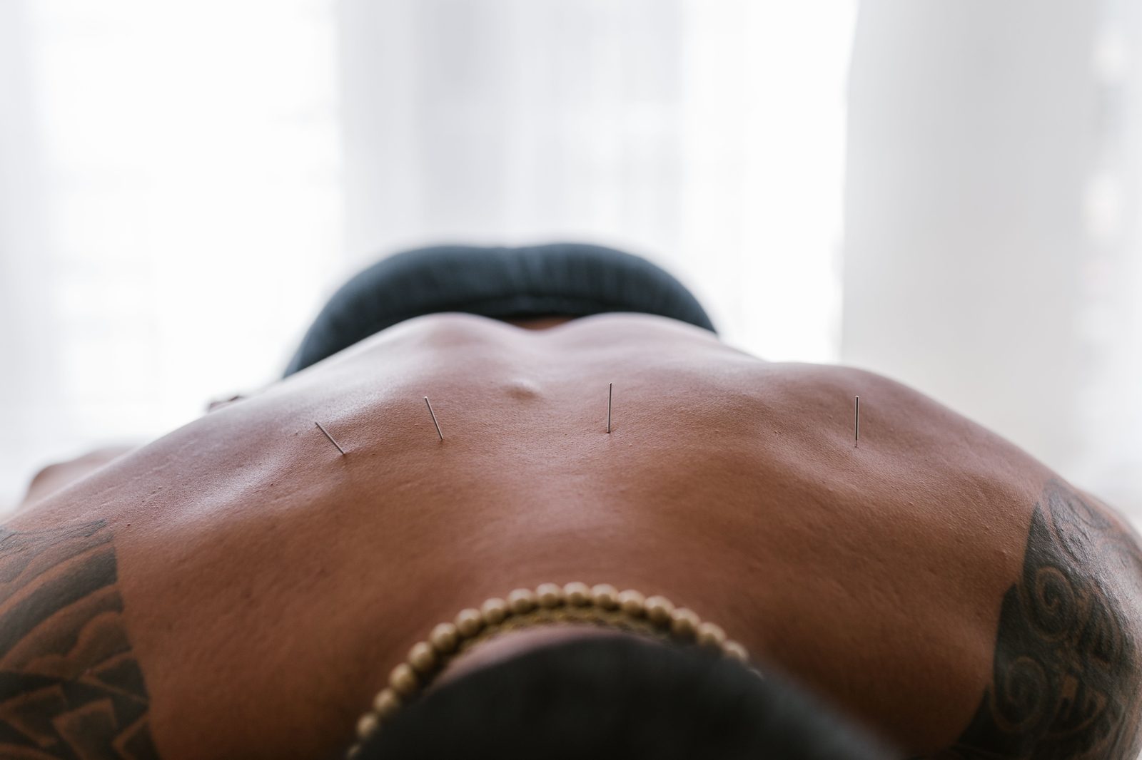 A calm acupuncture treatment in progress