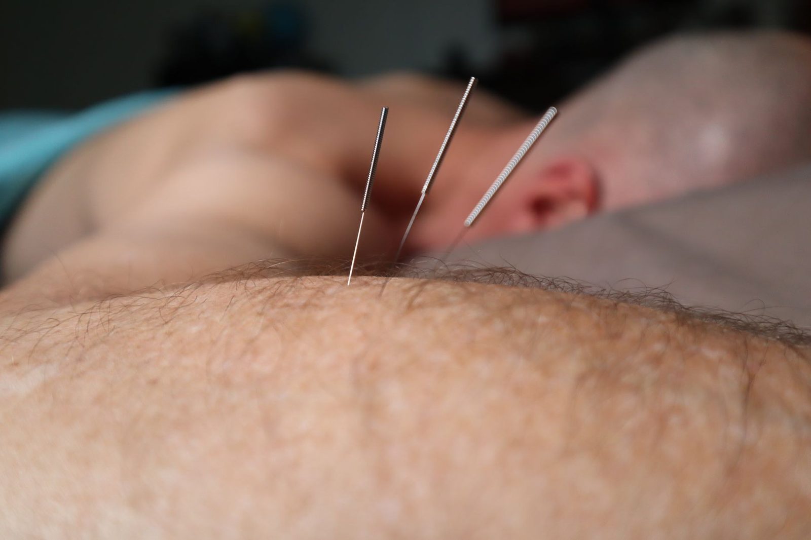 Acupuncture